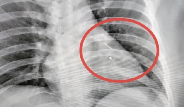 20대 남성, 심장 근처서 7cm 바늘 발견..어쩌다가?