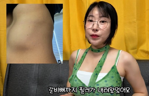 “가슴이 4개가 됐다” 이세영, 필러 부작용 사진 첫 공개 '충격'